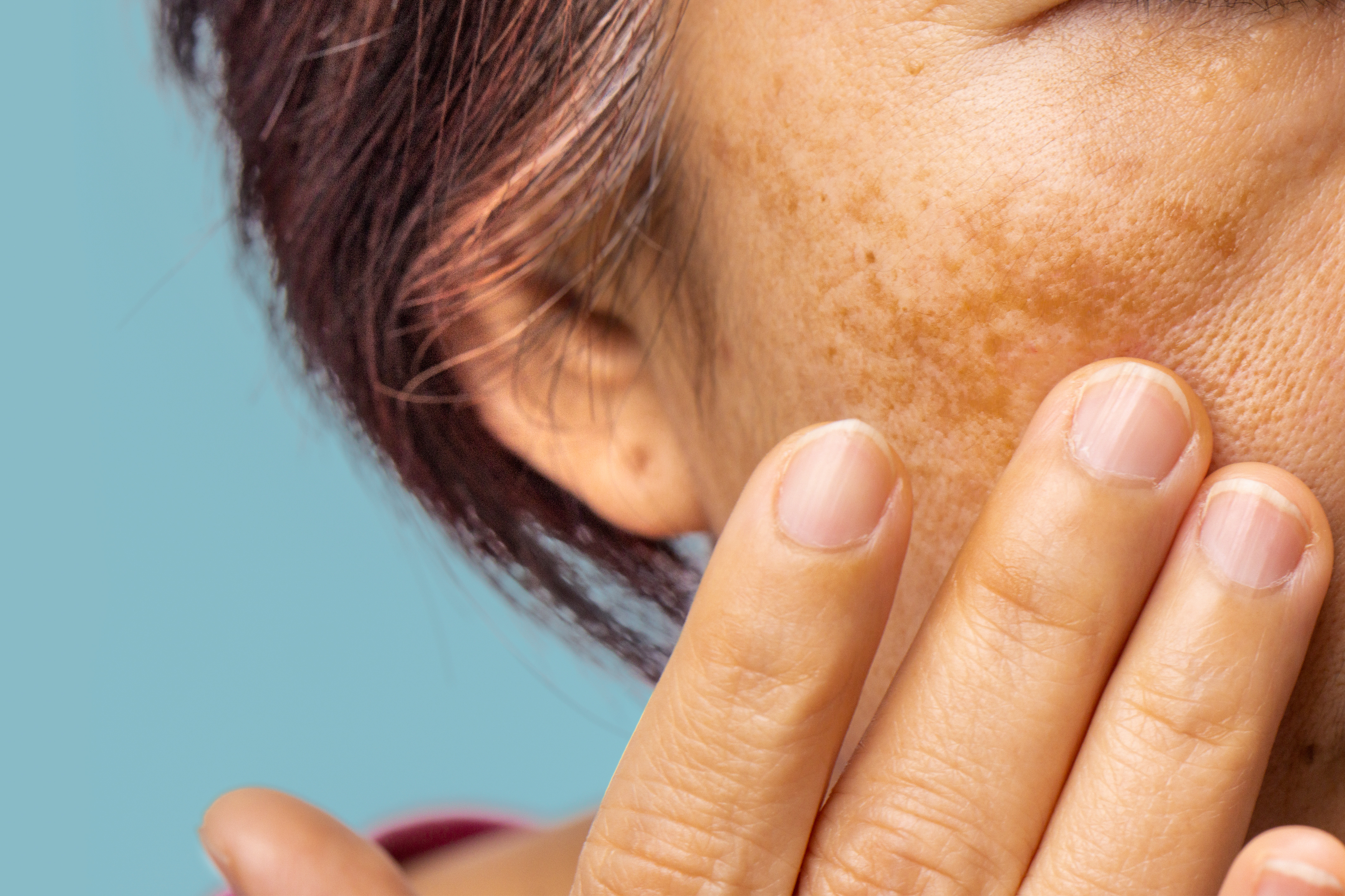 30~50代に多い肝斑